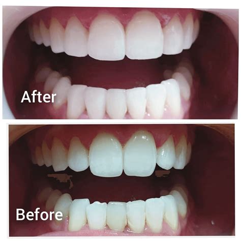 Teeth Bonding For A Beautiful Smile Mohip Dental