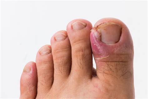 All About Ingrown Toenails Round House Podiatry