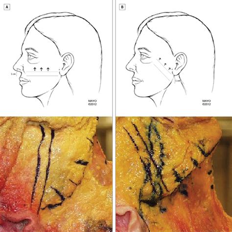 Anatomic Evaluation Of The Vertical Face Lift In Cadavers Brow Face Forehead Lift Jama