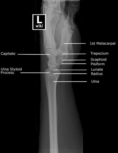 Radiographic Anatomy Wrist Lateral Radiology Schools Radiology