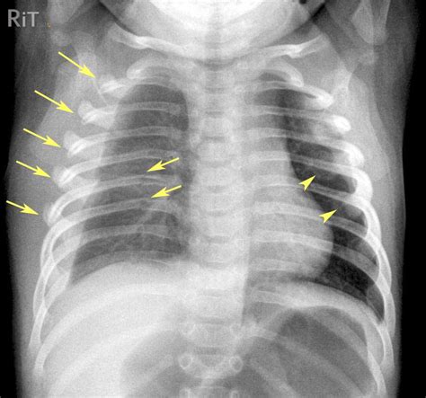 Rit Radiology Non Accidental Injury Nai Rib Fractures