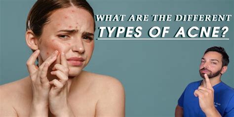 What Are The Different Types Of Acne Dermatologists Explain All