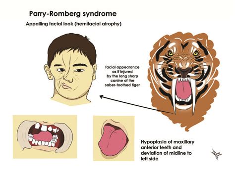 pdf parry romberg syndrome