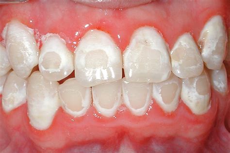 White Spots On Teeth After Braces Teethwalls