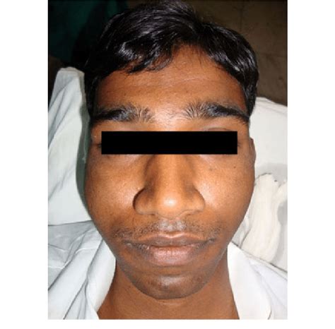 Preoperative Photograph Of The Patient Showing Slight Swelling At Right