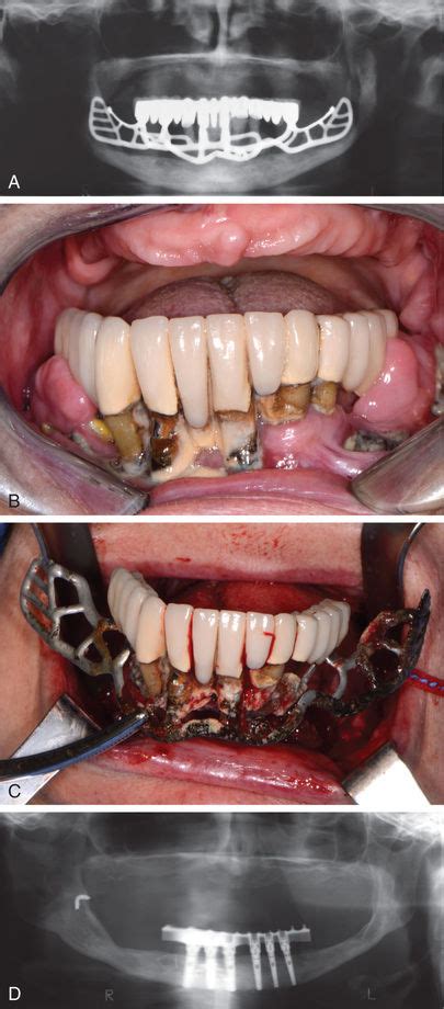 Intraoperative Complications Pocket Dentistry
