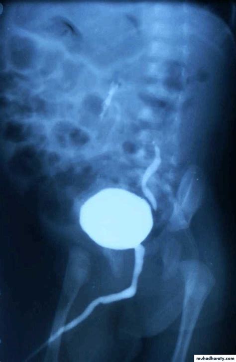 Ureteropelvic Junction Obstruction Pptx دمحمد فوزي Muhadharaty