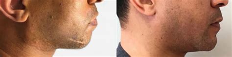 How Much Does A Chin Augmentation With Implants Cost Bala Cynwyd