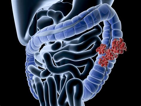 Colon Cancer Overview And More