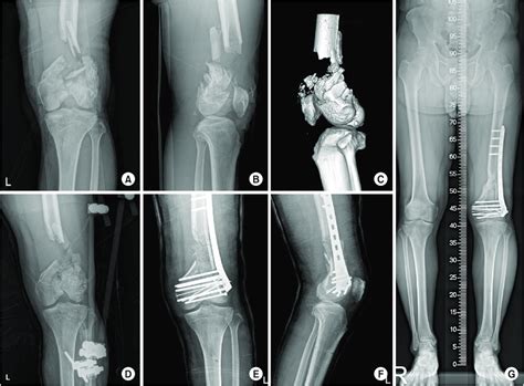 A B A 58 Year Old Man With An Open Distal Femoral Fracture He Had A