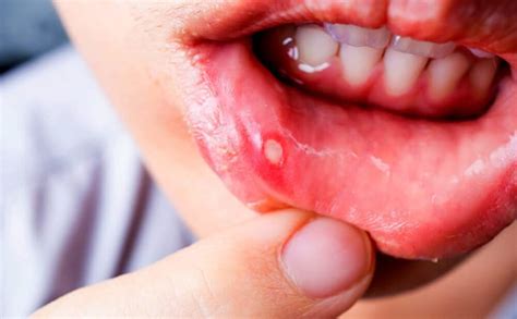 Know About Mouth Ulcer Its Causes And Remedies Bigumbrella