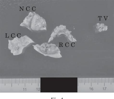 Figure 4 From A Calcified Amorphous Tumor From The Aortic Valve To The