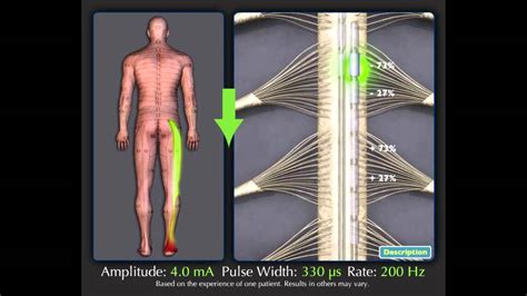 Spinal Cord Stimulation Overview Youtube
