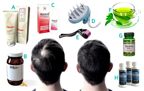 Most Effective Hair Loss Treatments For Males