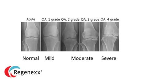 Explain My Knee Arthritis X Ray Youtube
