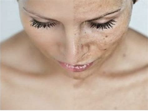 Chemical Peels Skin By Design Dermatology And Laser Center Pa