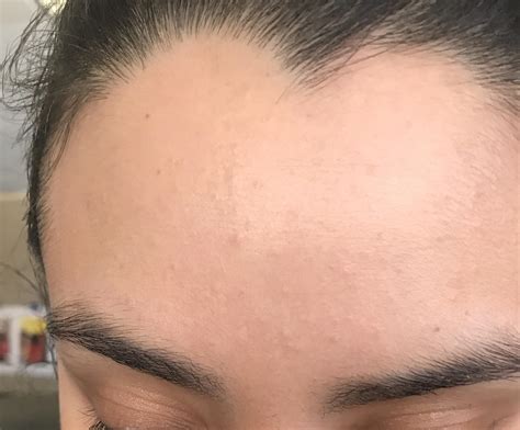Milia Clogged Pores Bumps Acne Symptoms