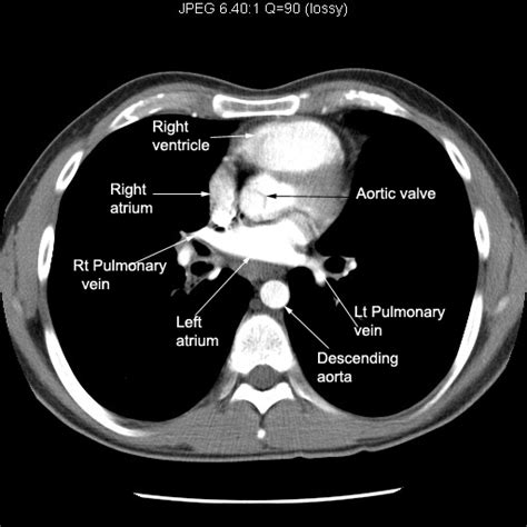 Aorta