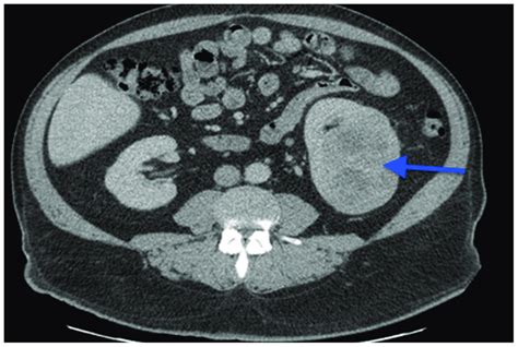 A Ct Scan Image Showing A 7 Cm Left Kidney Mass Download Scientific