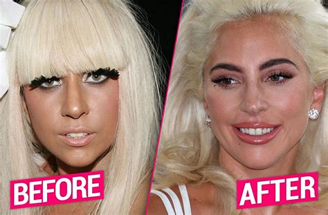 Lady Gaga S Plastic Surgery Makeover Exposed By Top Docs