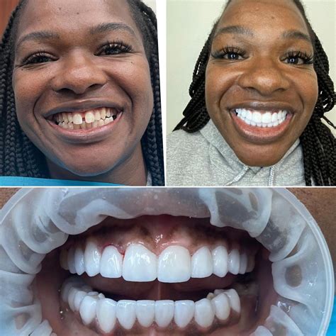 Transform Your Smile With Porcelain Veneers In Miami