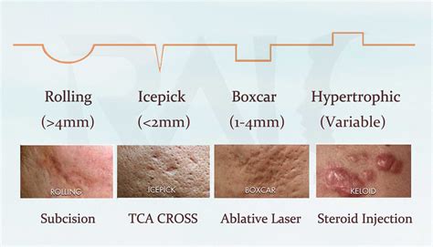 Different Types Of Acne Scarring
