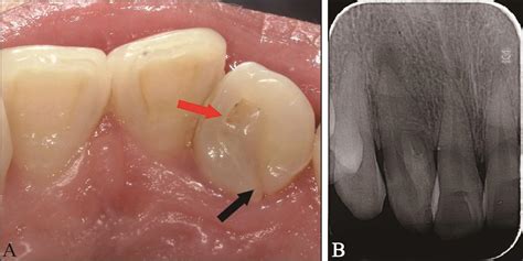 Root canal treatment of type Ⅱ and ⅢA double dens invaginatus in