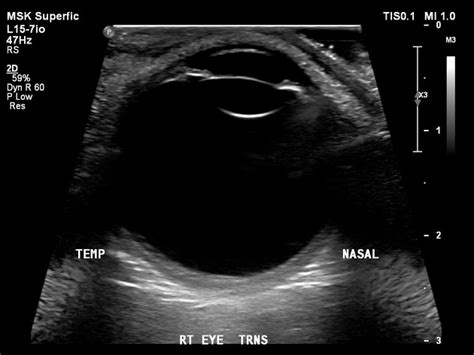 Eye Ultrasound