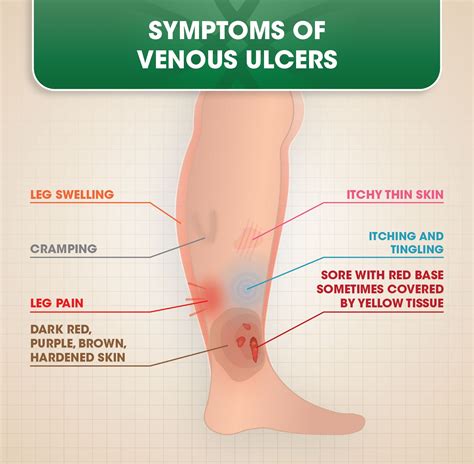 Venous Ulcers | Ulcers, Leg ulcers, Skin ulcer