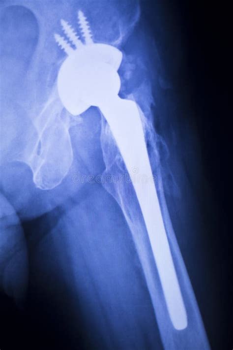 Hip Joint Replacement Xray Stock Photo Image Of Plate 84257524