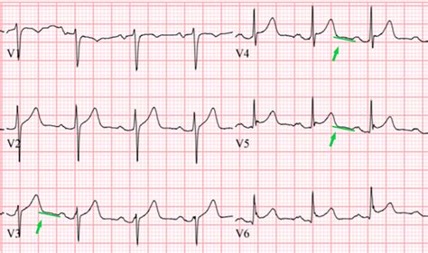 Cureus Acute Myopericarditis In The Post Covid 19 Recovery Phase
