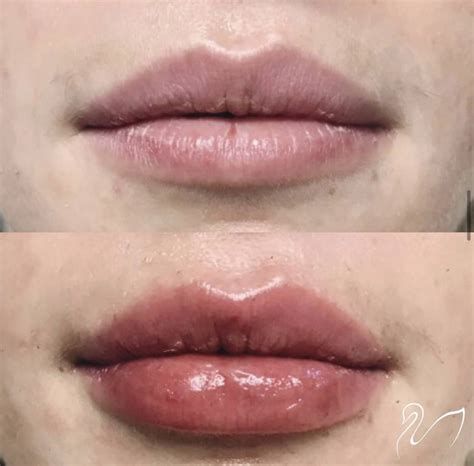 Volbella Lips Before And After 1 Syringe