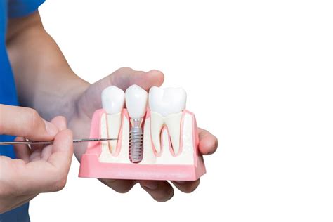 The Timeline Of A Dental Implant Surgery In Detail