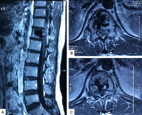 Figure 1 From Giant Cell Tumor Of Thoracic Spine Misdiagnosed As