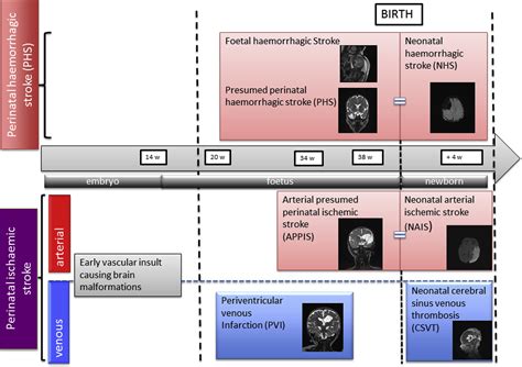 Perinatal Stroke Syndromes Similarities And Diversities In Aetiology