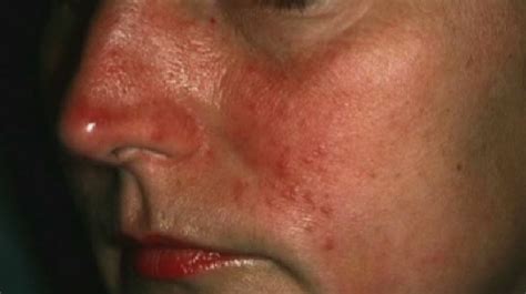 Rosacea Itchy Scaly Red Patchy Skin On Your Face Patchy Skin Rosacea