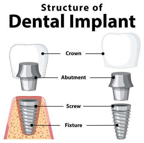 Healing Cap For Dental Implants