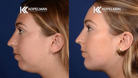 Chin Implant Before And After Gallery Plastic Surgery With Dr Kopelman