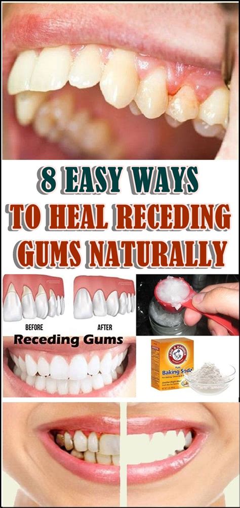 8 Easy Ways To Heal Receding Gums Naturally Receding Gums Gum Health
