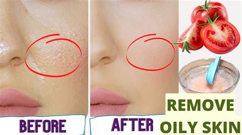How To Get Rid Of Oily Skin Permanently Home Remedies For Oily Skin And Pimples Get Glowing