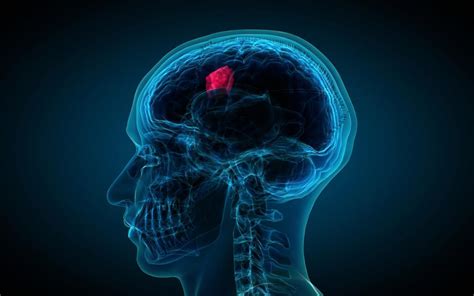 Glioblastoma Um Novo Tratamento Para Este Tumor Cerebral Mortal