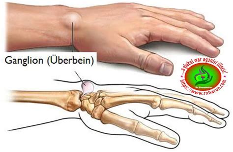 Ganglion Cyst Causes Symptoms Diagnosis Treatment Rxharun