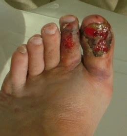 Sprain broken big toe pictures. Warning: Flip-flops are a health hazard