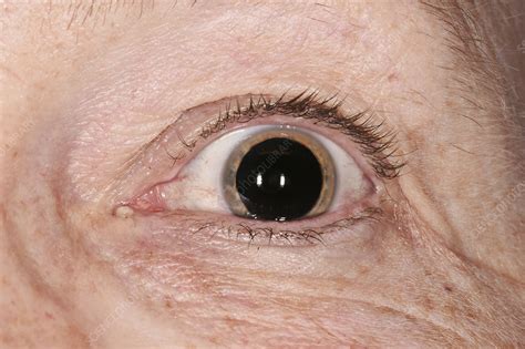 Dilated Pupil For An Eye Examination Stock Image C040 1426 Science Photo Library