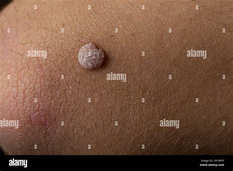 Close Up Of Wart On Boys Arm Stock Photo Alamy