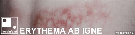 Erythema Ab Igne Info Van De Dermatoloog