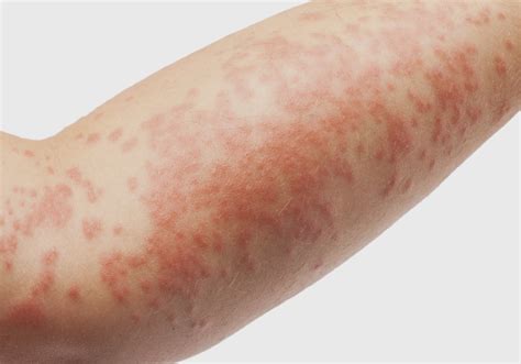 Novo Tratamento Para Dermatite Atópica é Aprovado Pela Anvisa