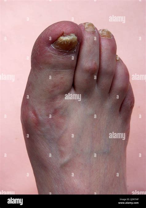 Toenail Fungal Infection Onychomycosis Stock Photo Of Yellow Nails