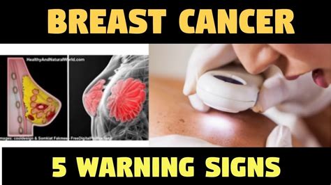 ATTENTION Warning Signs Of BREAST CANCER That Many Women Ignore YouTube