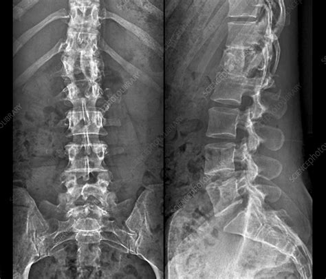 Fixed Spinal Fracture X Ray Stock Image C0252510 Science Photo